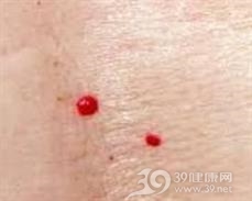 红痣