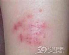 红疹