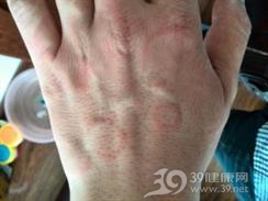 环状红斑