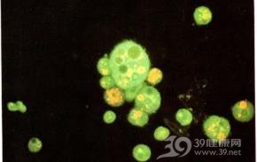棘阿米巴性巩膜炎