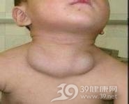 颈部囊状淋巴管瘤