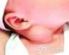 颈部纤维瘤