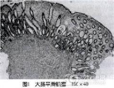 结肠平滑肌瘤
