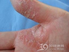 角层下脓疱性皮肤病