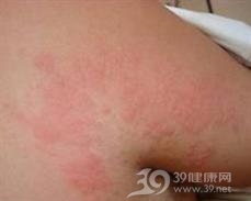 接触性皮炎