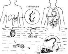 间插血吸虫病