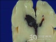 基底节血肿