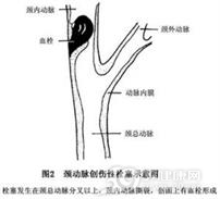 颈动脉创伤性栓塞
