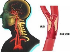 颈动脉硬化