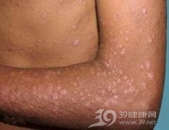 Jessner淋巴细胞浸润