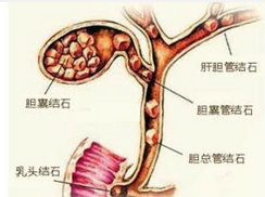 继发性胆总管结石