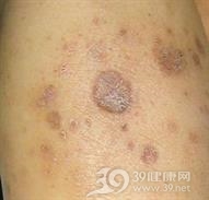 继发性皮肤CD30阳性大细胞淋巴瘤