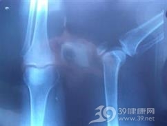 胫骨髁骨折