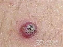 角化棘皮瘤