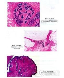 结节性筋膜炎