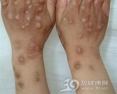 结节性痒疹