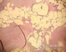 结节性脂肪坏死