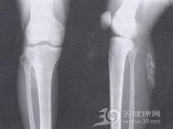 焦磷酸钙沉积病