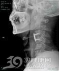 棘突骨折