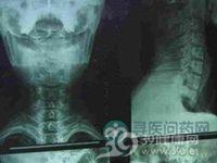 棘突压痛