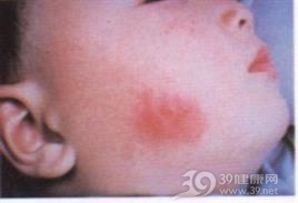急性单纯疱疹病毒性脑炎