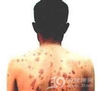 急性蜂窝织炎
