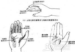 急性化脓性腱鞘炎