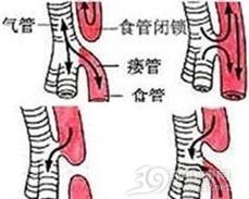 畸形性吞咽困难