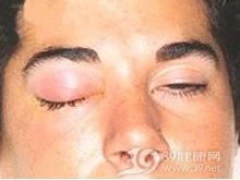 急性眼眶蜂窝织炎