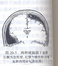 急性硬脑膜下血肿