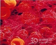 急性杂合性白血病