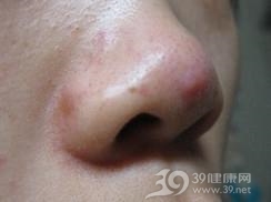 酒渣鼻