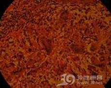 酒渣鼻样结核疹