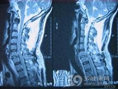 颈椎骨折脱位