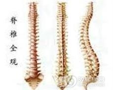 脊椎结核并发截瘫