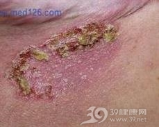 家族性良性天疱疮
