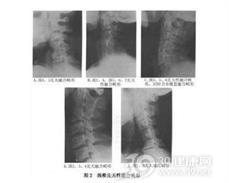 颈椎先天融合畸形