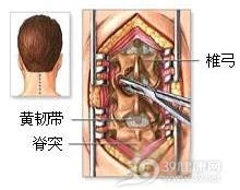 颈椎椎弓裂