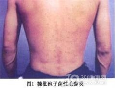 糠秕孢子菌毛囊炎