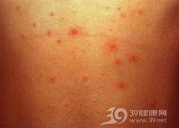 卡波西水痘样疹