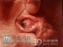 克里米亚-刚果出血热