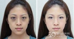 眶周色素沉着