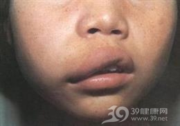 淋巴管瘤