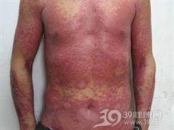 淋巴瘤样丘疹病