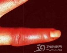 类丹毒