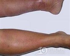 类固醇后脂膜炎