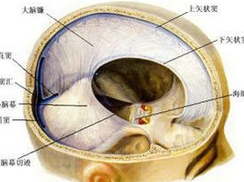 颅后窝血肿