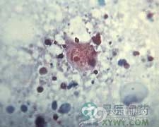 流行性斑疹伤寒