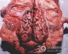流行性甲型脑炎
