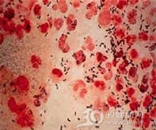 淋菌性咽炎